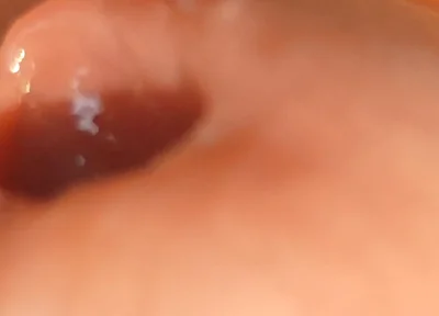 The Great Transformation of Phimosis Elastica.