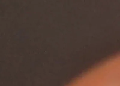 The Great Transformation of Phimosis Elastica.