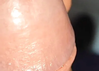 Extreme Application to the Syringe Inside the Glans!!