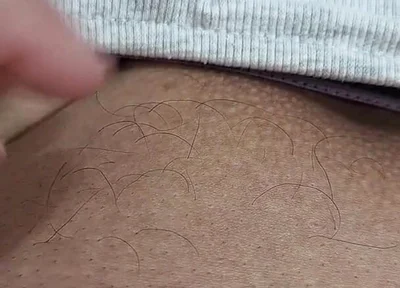 The Hair on My Penis - Led Hair Removal