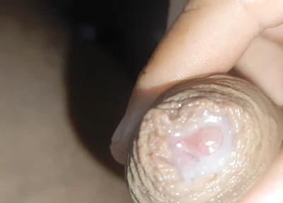 I Have the Largest Ejaculating Phimosis in the World!!
