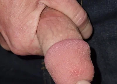 Gaping Urethra - Marker and Pinky Insertion