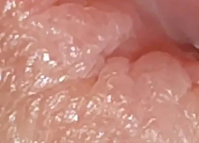 Enlargement of the Deep Urethral Hole!!