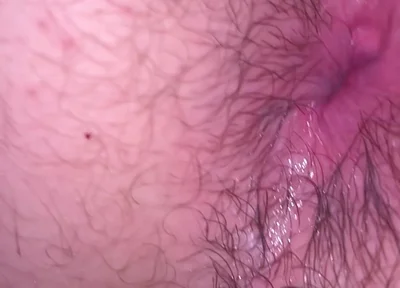Bruised Asshole