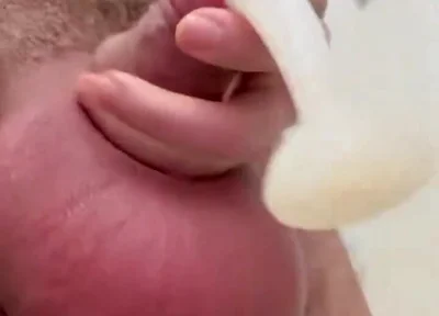 Inflated Ball Sack with Saline