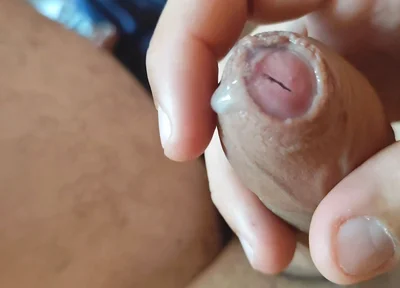 Dilation of the Corpus Cavernosum Exposes Spongy Foreskin.