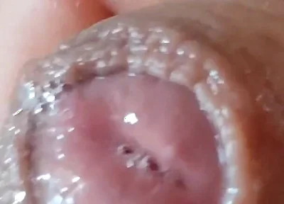 Deep Split in the Glans Produces Bubbling Liquid