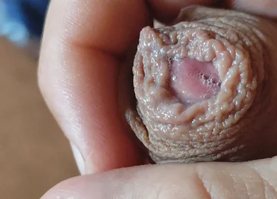 Deep Split in the Glans Produces Bubbling Liquid