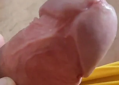 Scarred Frenulum Causes Glans Erection!