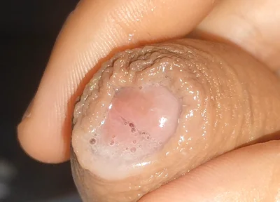 Curious Close-up of Pre-cum in Flaccid Phimosis.