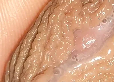 Curious Close-up of Pre-cum in Flaccid Phimosis.
