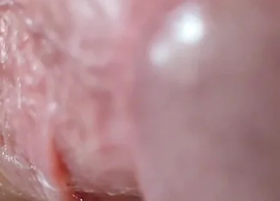 Opening the Scar of the Rough Frenulum!