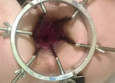 Enema, Anal Shower. Close-up View Through Anal Mirror. Anal with Water. Filling Anal with Water