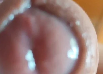 The Glans Appears Crowning Inside the Phimosis.