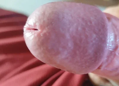The Blossoming of Extensive Elastic Phimosis.