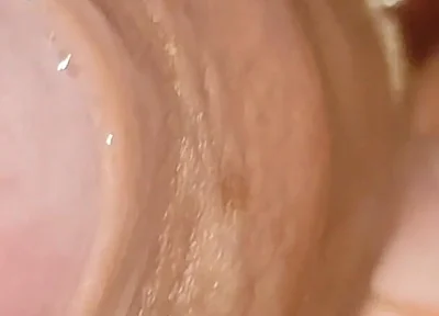 Large Cheese Accumulated in Close up of Glans