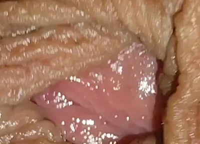 Boy with Large Anal Phimosis Excited!