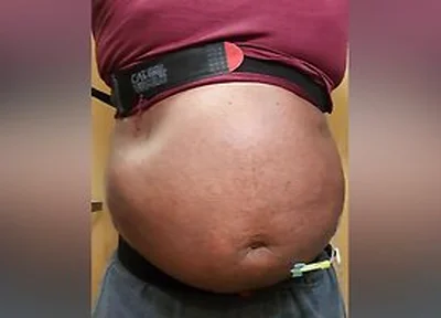 N2o Belly Inflation