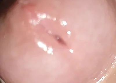 Maximum Dilation of Phimosis Cumming.