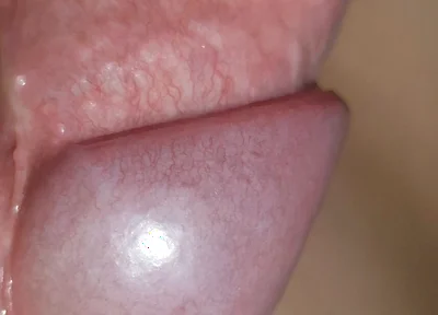 Amazing Upright Rough Venous Frenulum