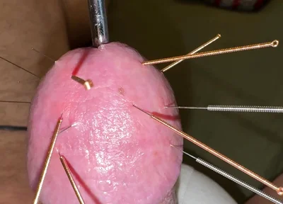 Acupuncture - Orgasm!
