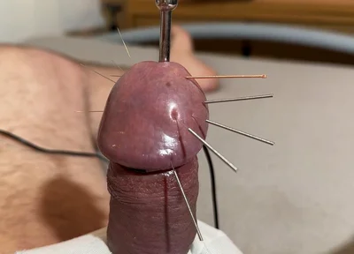 The Best Acupuncture Method!
