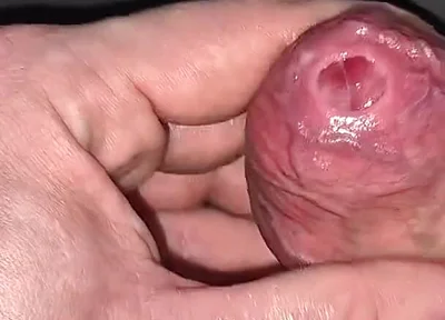 A Closer Look at My Naturally Tight Phimosis