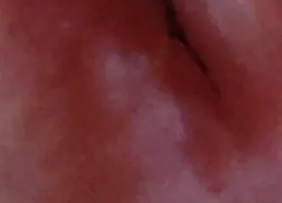 Dilation of the Glans Eye Has a Pleasant Surprise.