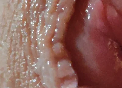 Dilation of the Glans Eye Has a Pleasant Surprise.