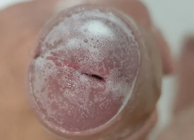 Extreme Burning Sensation Makes the Glans Foam with Arousal.
