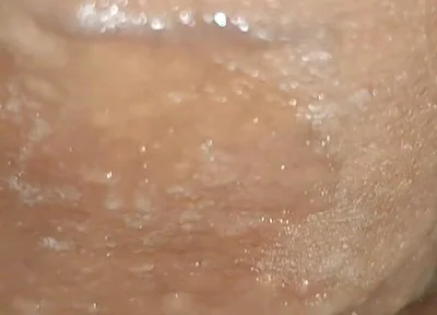 Scrotal Phimosis Results in an Extremely Hot Orgasm.