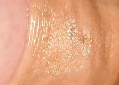 Difficult Fluid Control Due to Straight Phimosis.