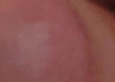 Immense Phimosis Being Extracted Cum and Précum.